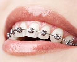Braces Treatment & Orthodontics